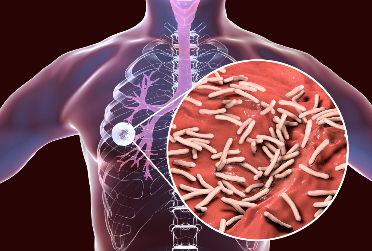 Xanxerê registra três casos de tuberculose em humanos